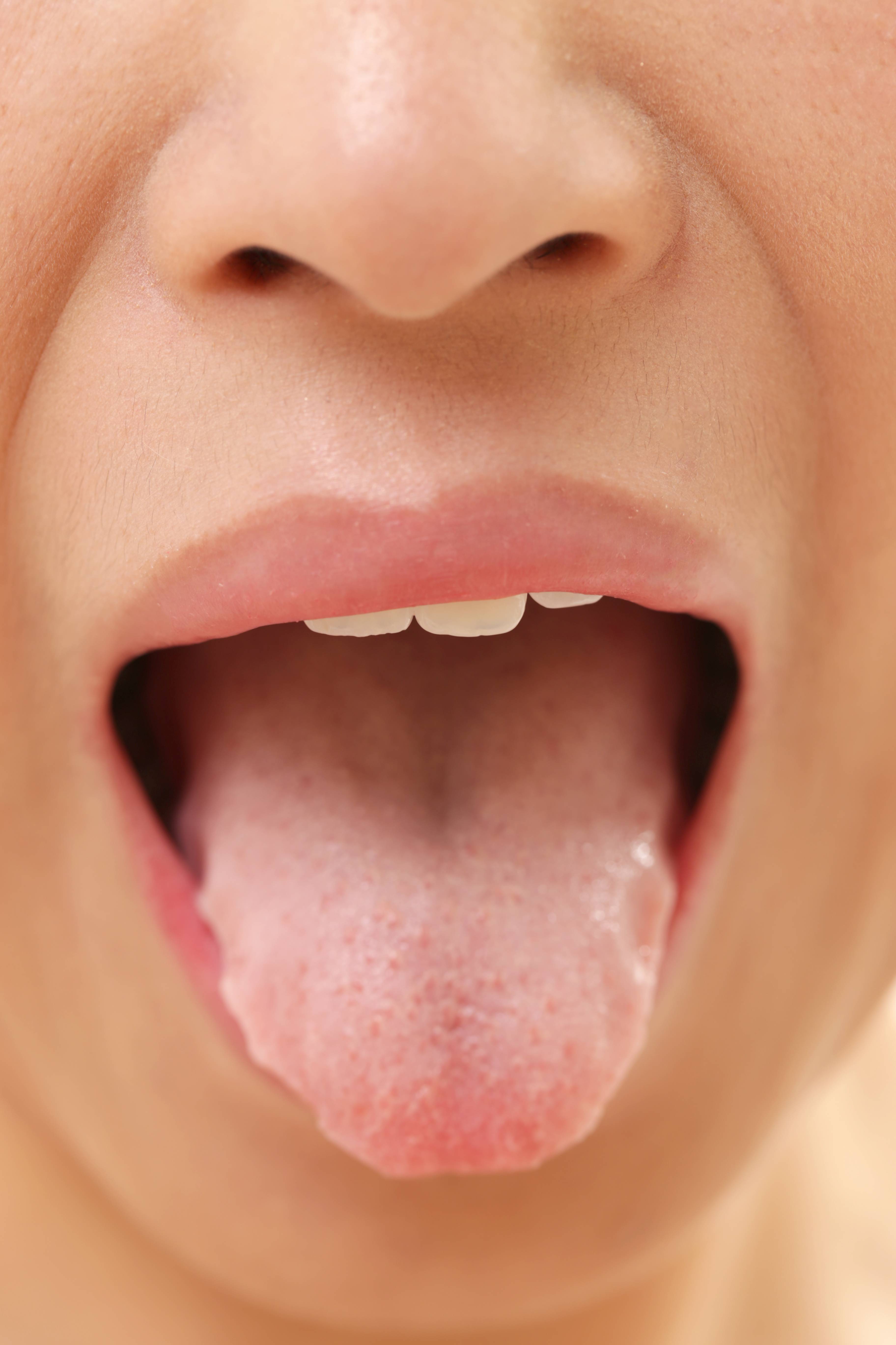 Сухость во рту при коронавирусе: чем полоскать рот при коронавирусе