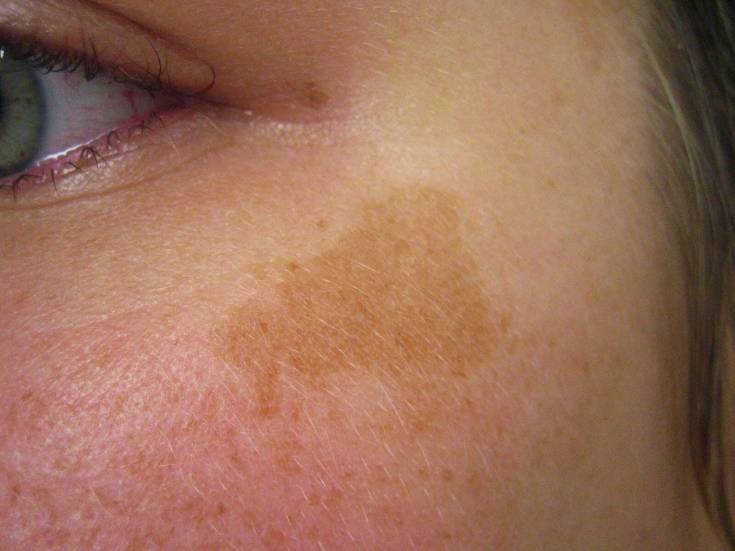 Возрастные пигментные пятна на лице и коже: причины и лечение