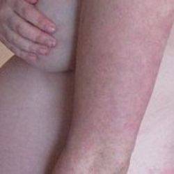 Высыпания на лбу у женщин. причины мелкой сыпи на лице, аллергия, фото, лечение в домашних условиях