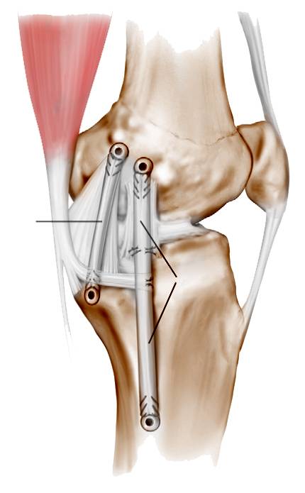 Операция колено пкс. Пластика MPFL коленного сустава. Пластика ПКС коленного сустава. Повреждение коллатеральной связки коленного.
