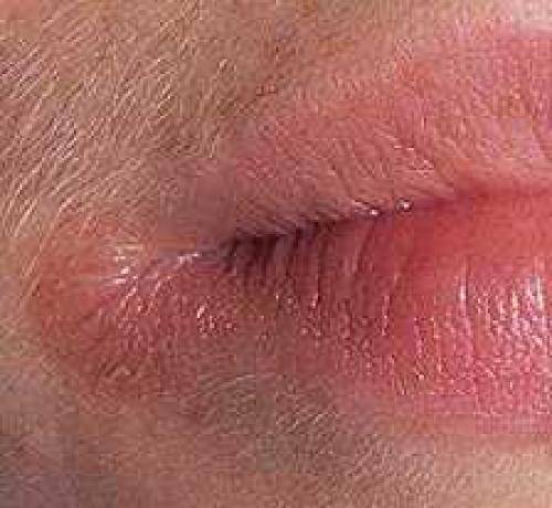 Чем лечить уголки губ у ребенка и взрослого