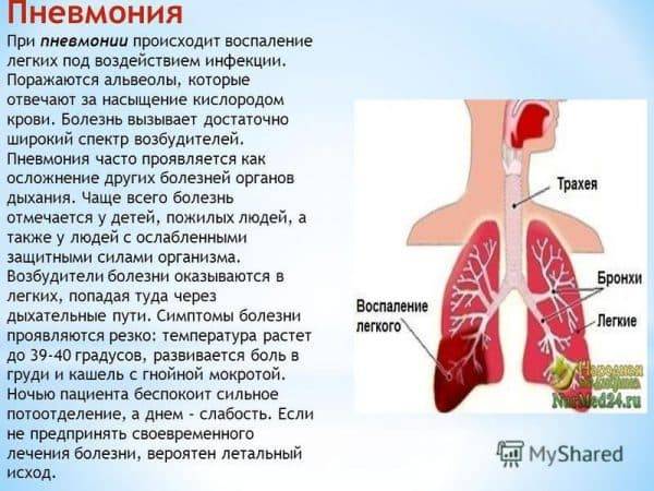 Двухсторонняя пневмония: что это такое?