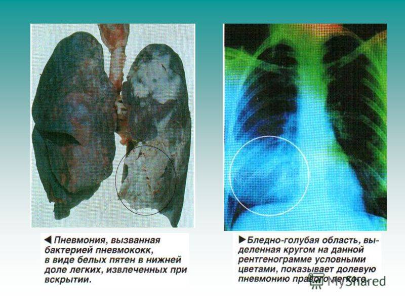 Чем опасна двусторонняя пневмония? не затягивайте с визитом к врачу!