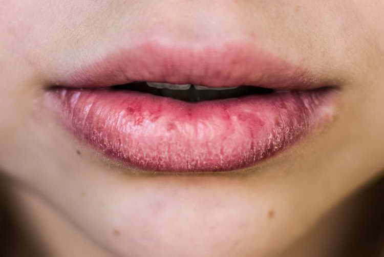 Губы трескаются и шелушатся - причины и лечение, что делать | здрав-лаб