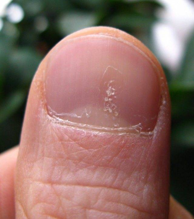 Причины, из-за которых облазит кожа на пальцах рук: симптомы и лечение в домашних условиях