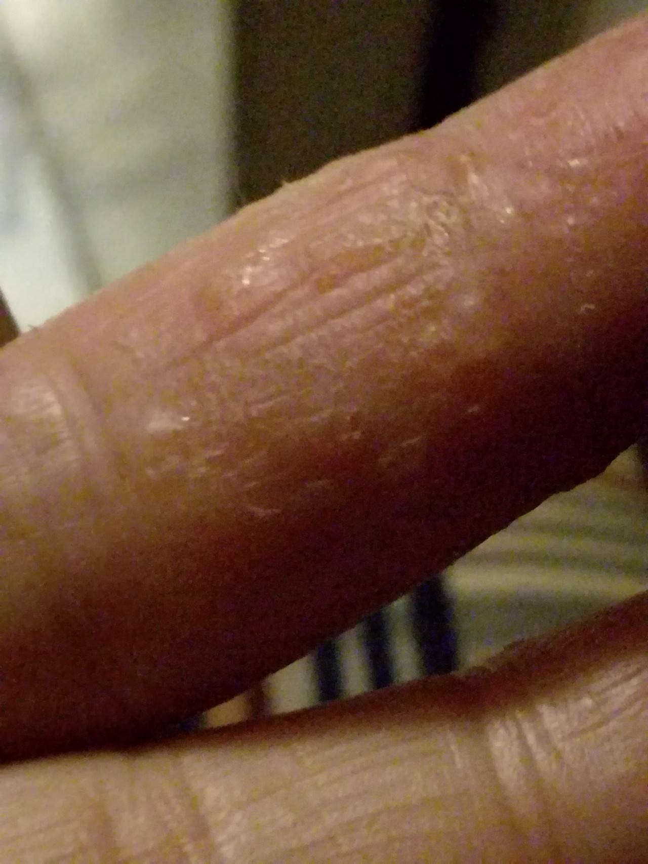 Пузырьки на пальцах рук: водянистые, лопаются, трескаются, у ребенка, чешутся, герпес, мелкие, фото, как лечить