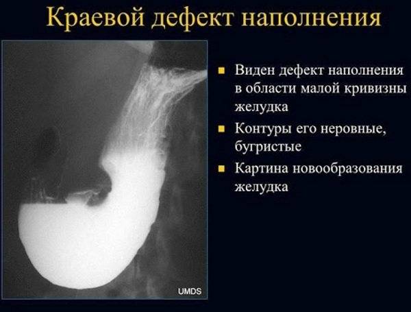 Что показывает рентген желудка с барием: для чего нужен и как проводится