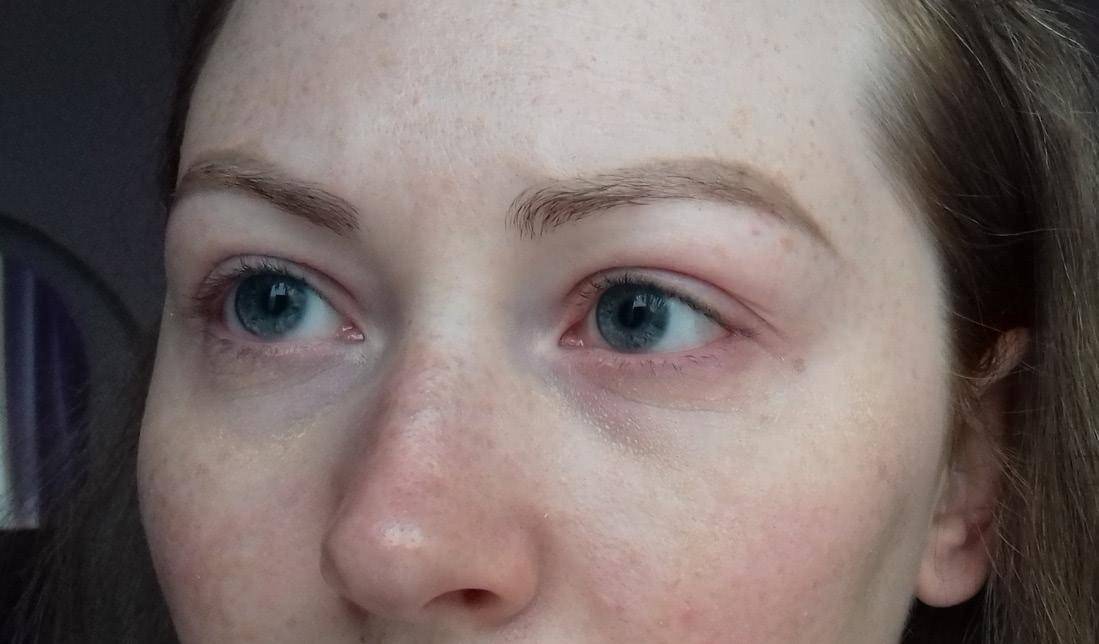 Красные пятна под глазами - причины шелушения вокруг глаз