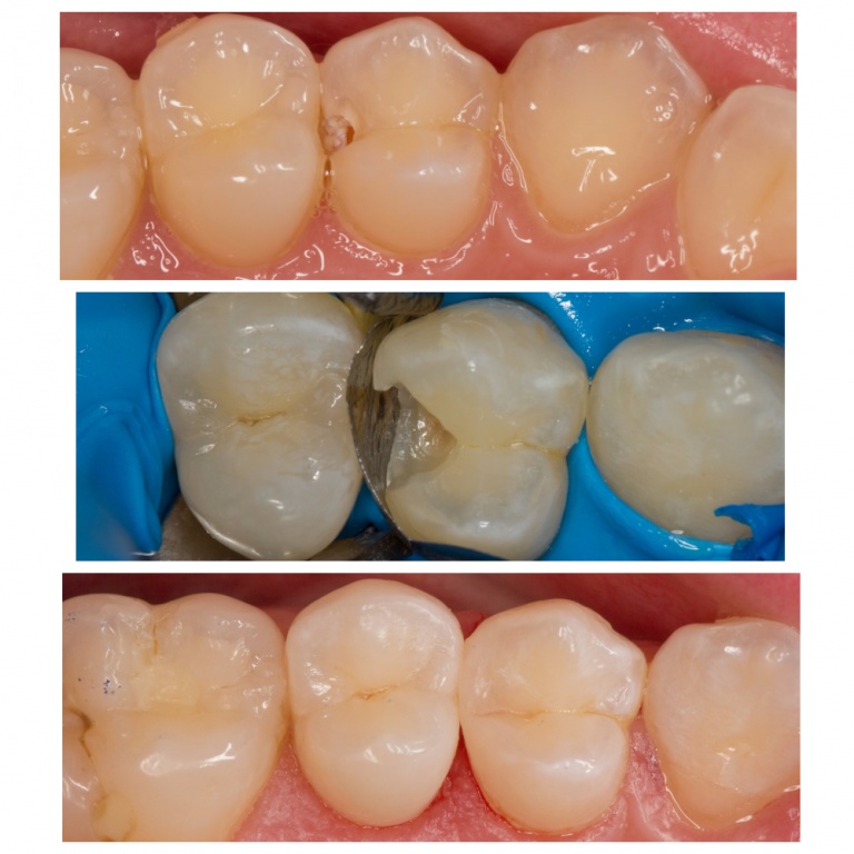 Лечение глубокого кариеса зубов - цена, материалы, этапы и методы