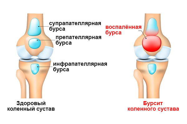 Этиология, клиника и терапия супрапателлярного бурсита коленного сустава