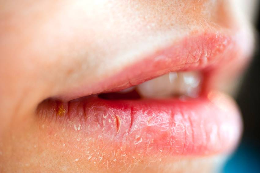 Заеды в уголках рта: причины и лечение у детей - чем мазать уголки губ ребенка? | spacream.ru