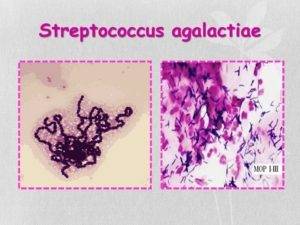Стрептококк агалактия в мазке из цервикального канала