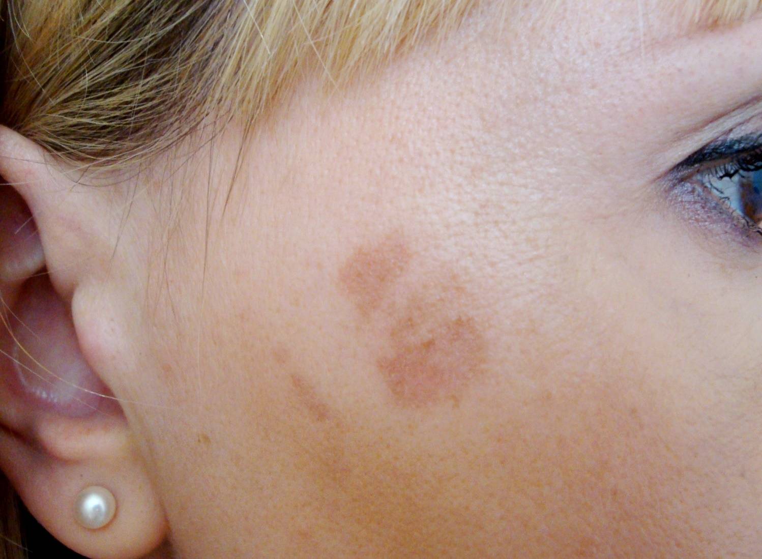 Возрастные пигментные пятна на лице: как избавиться в домашних условиях | mfarma.ru