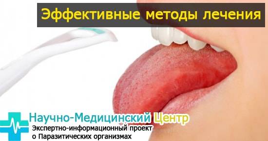 Кандидоз полости рта: фото языка, горла, симптомы во рту, ротовой полости у детей