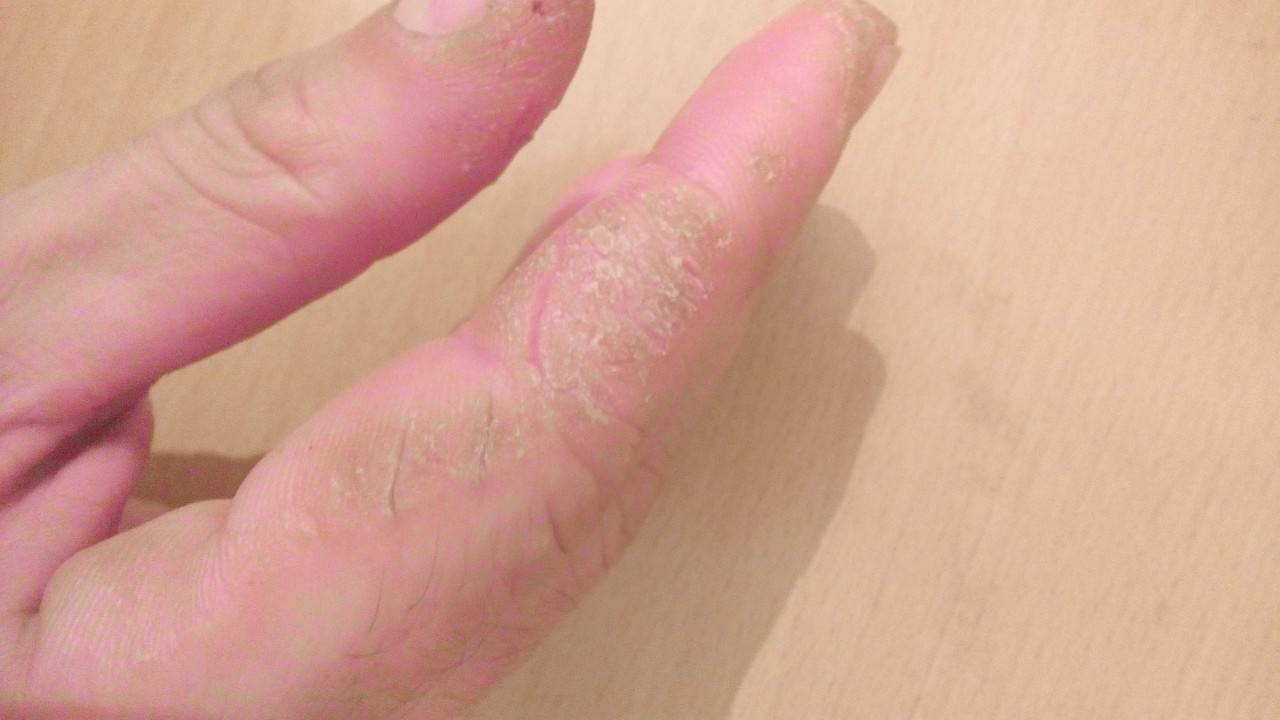 Трещины на пальцах рук: отчего и как лечить?
