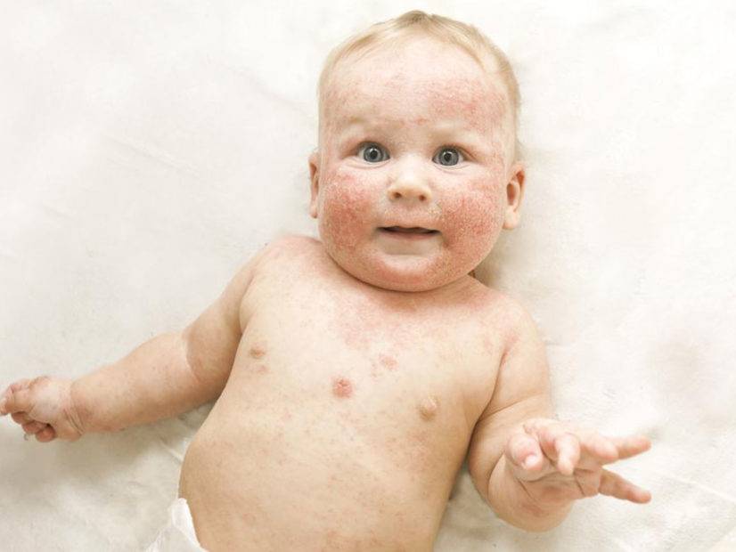 Вирусная пузырчатка у детей - фото, причины возникновения, лечение, симптомы, доктор комаровский