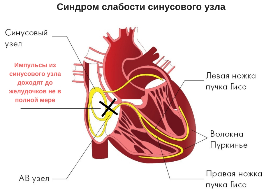 Сердце синусовый. Синусовый узел сердца. Синусный узел сердца расположен. Пучка Гиса и волокна Пуркинье. Проводящая система сердца волокна Пуркинье.