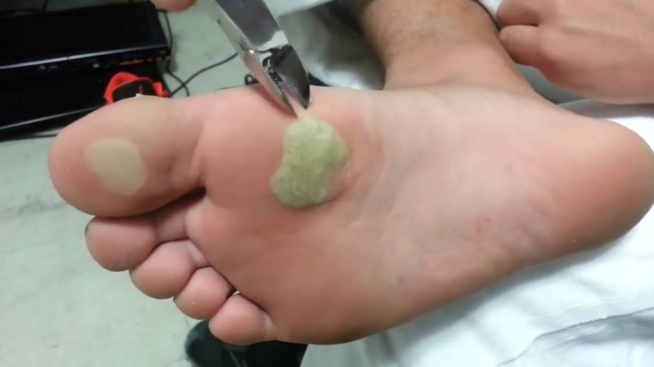 Как убрать сухую мозоль на пальце ноги в домашних условиях, лечение