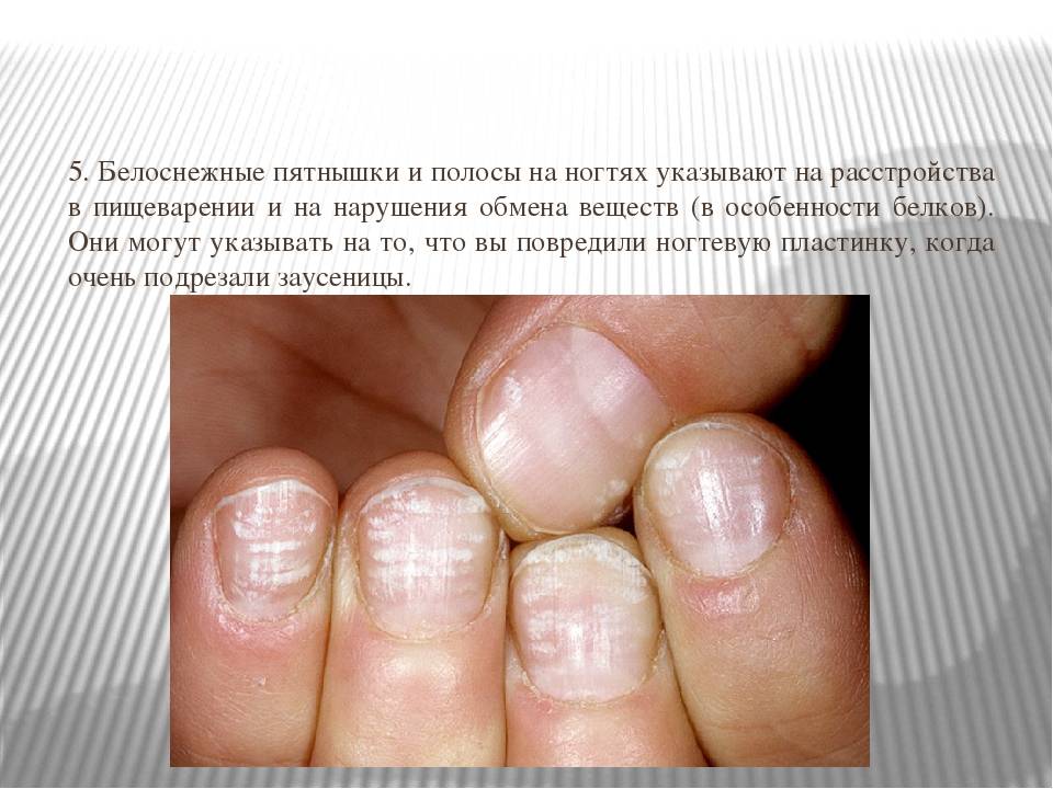 Белые пятна на ногтях у ребенка: признак болезни?