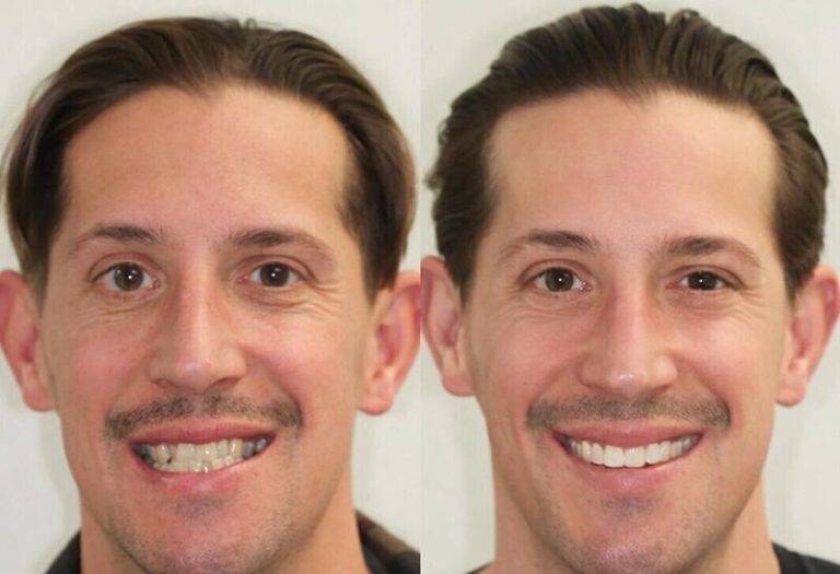 Полная смена образа: как меняется лицо после брекетов?