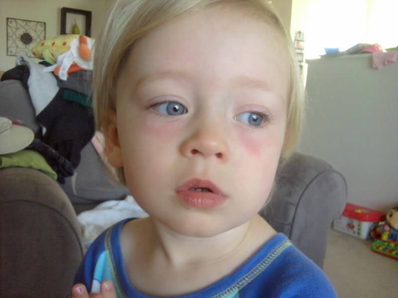 10 причин синяков под глазами у ребенка: варианты нормы и симптомы патологии