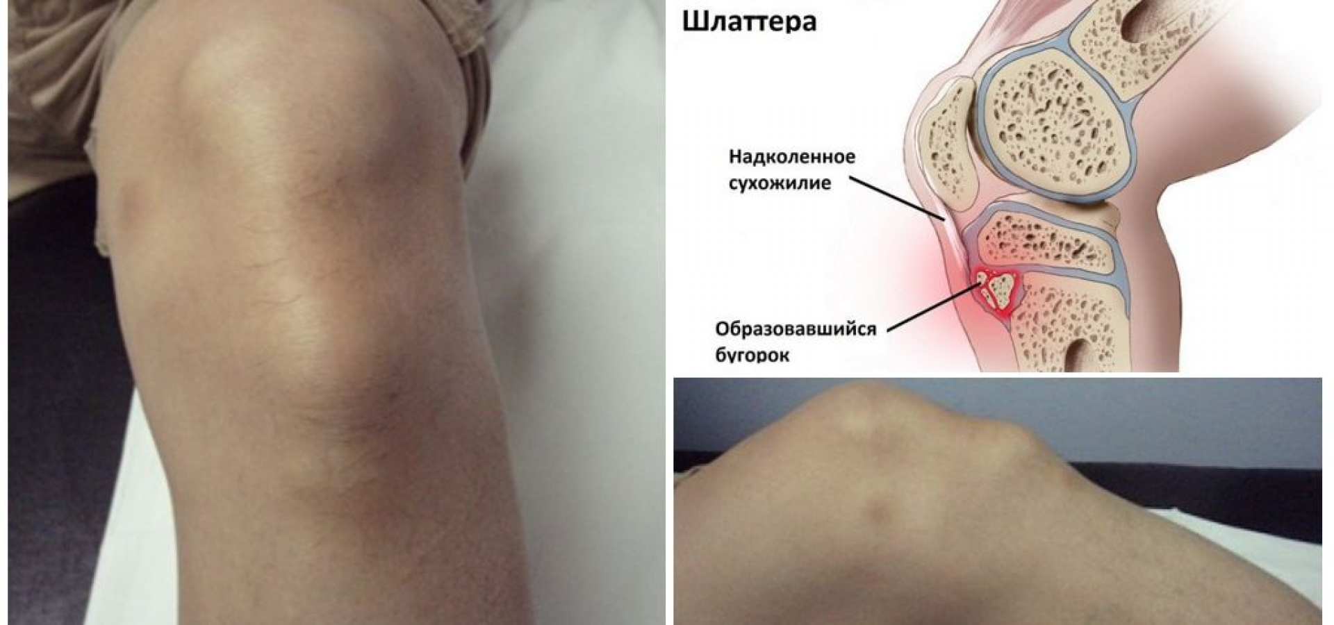 Болезнь осгуда-шляттера коленного сустава: лечение 