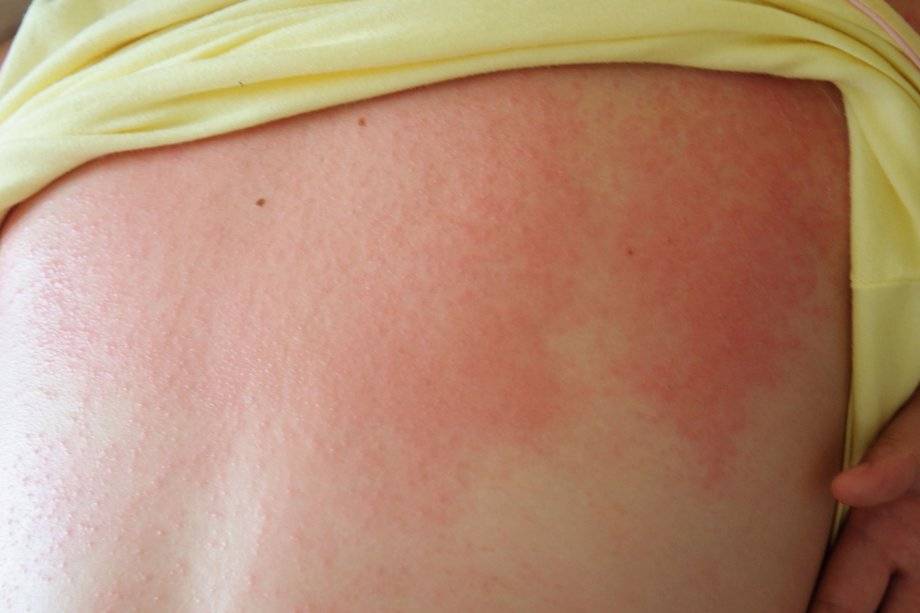 Виды аллергии на коже с фото