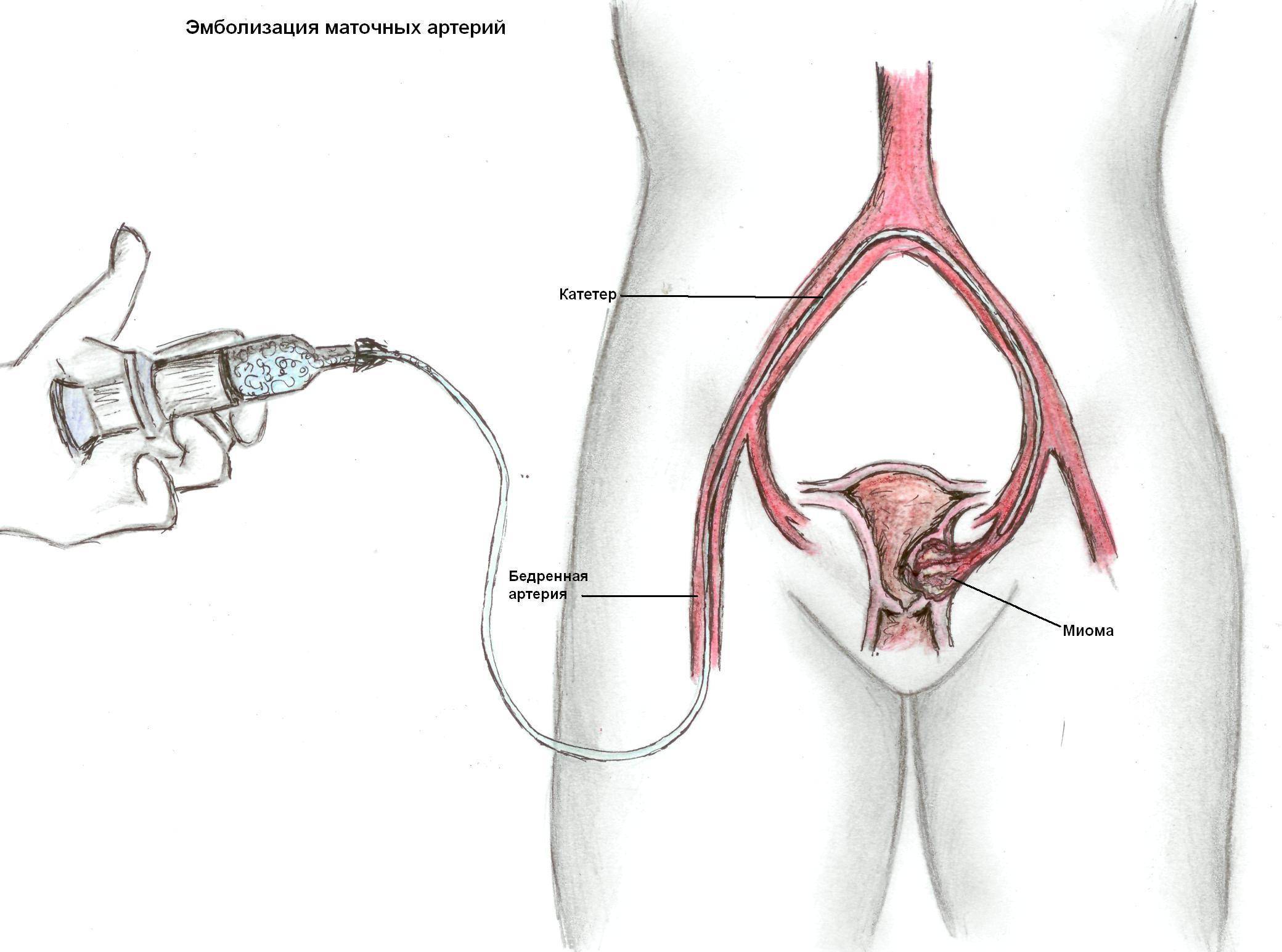 Эмболизация маточных артерий (эма): малоинвазивная операция при миоме