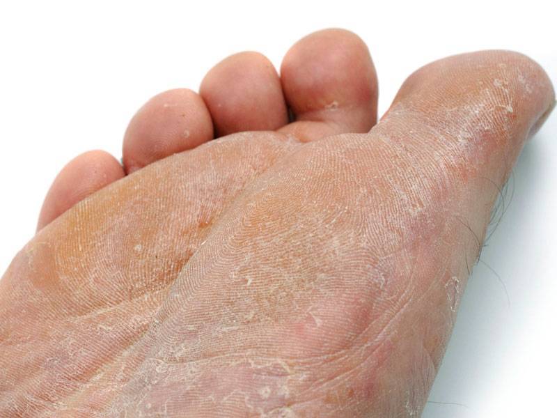 Шелушится кожа на ногах: что делать, как лечить