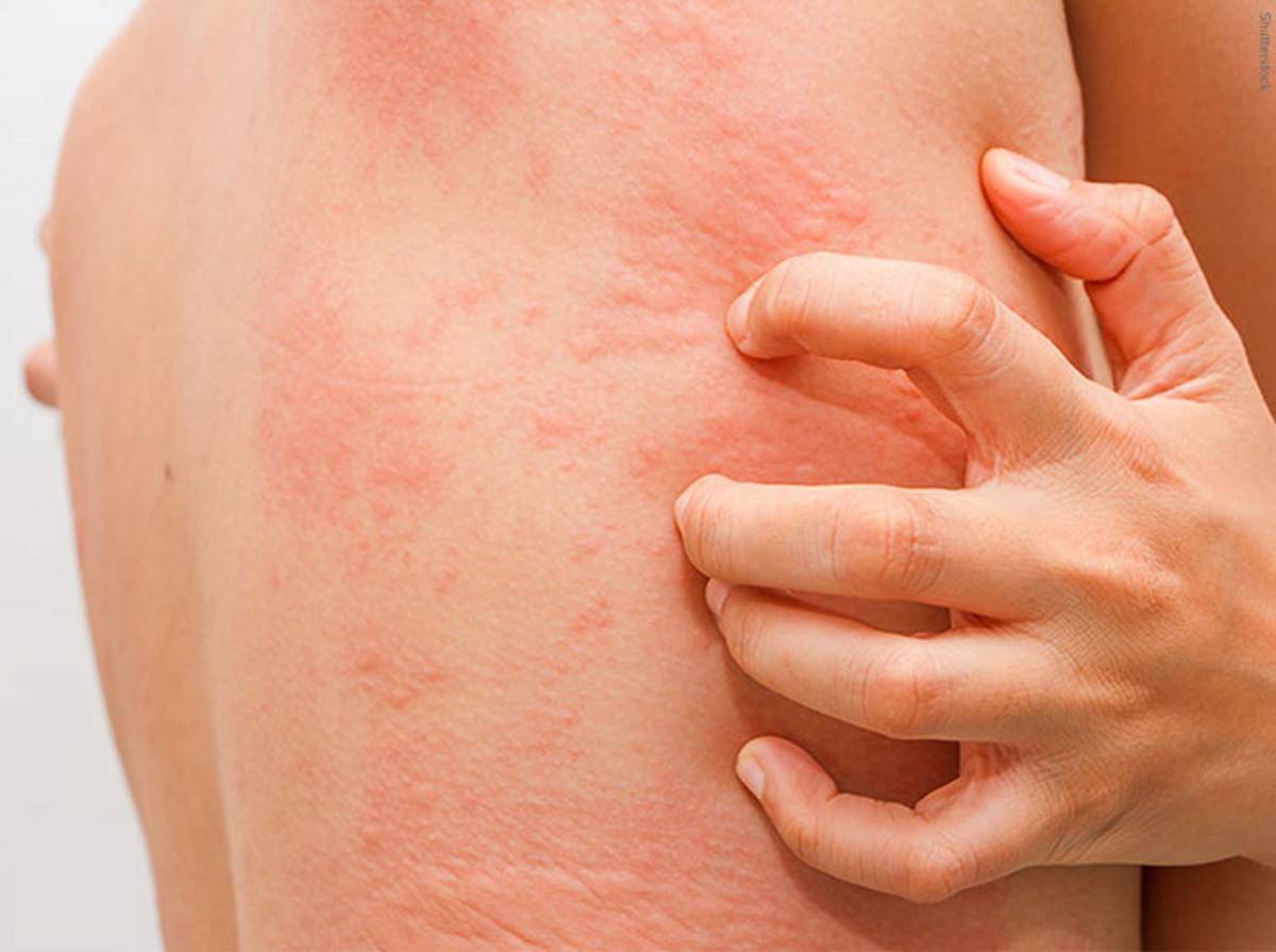 Аллергия у детей, фото различной сыпи на теле, лице и спине