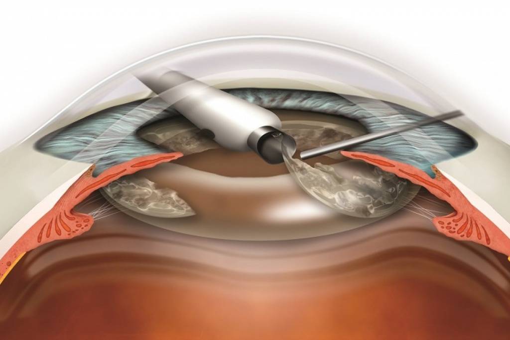 Как проводится операция катаракта?