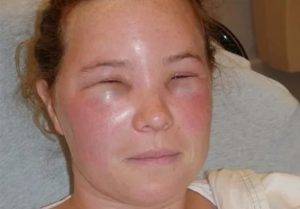 Как выглядит аллергия на лице: причины, симпомы, лечение, фото
