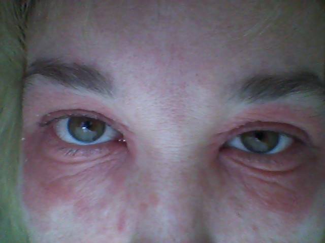 Аллергия: красные глаза у взрослых, причины и лечение симптома покраснения