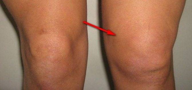 Супрапателлярный бурсит коленного сустава - симптомы и методы лечения - твой суставчик