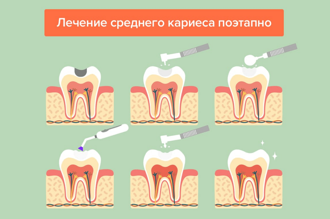 Кариес корня зуба - лечение под пломбой и коронкой