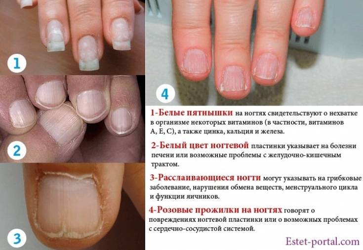 Причины и лечение белых пятен на ногтях пальцев рук