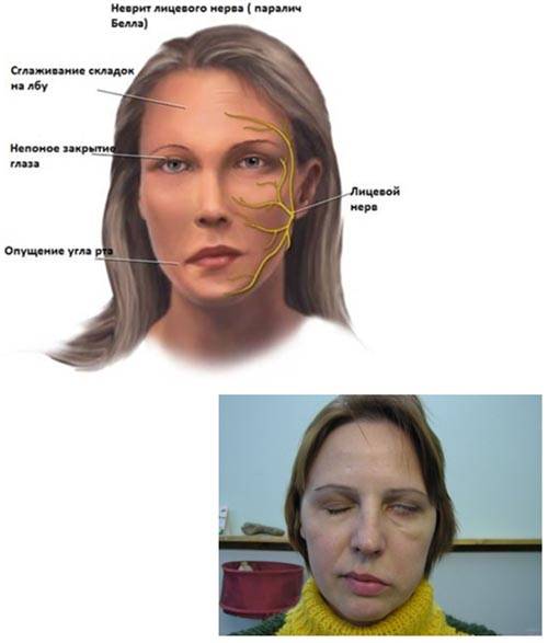 Лечение неврита лицевого нерва в домашних условиях