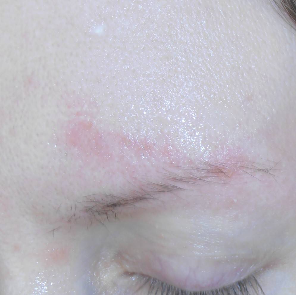Пятна на коже – виды аллергии, диагностика, лечение