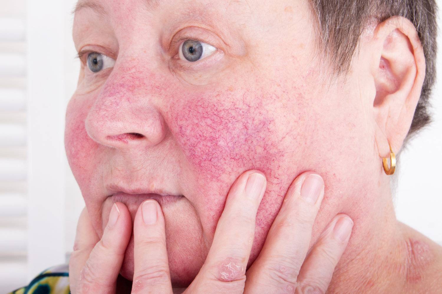 Покраснение щек: банальная аллергия или опасное заболевание? причины и лечение красноты