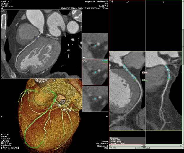 Мультиспиральная компьютерная томография сердца и коронарных артерий сделать в клинике цэлт!