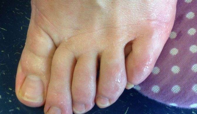 Шелушится кожа между пальцами ног, причины и лечение