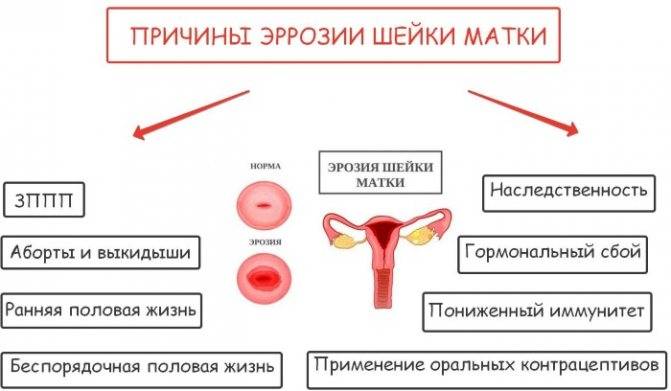 Гипоплазия матки, симптомы, степени, последствия, лечение и прогноз