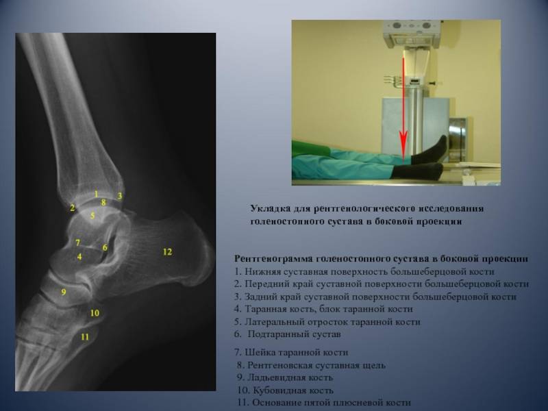 Рентген стопы, что показывает рентгенография (с нагрузкой, в двух проекциях)