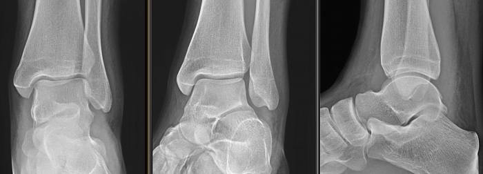 Рентген стопы – что показывает, в каких проекциях делают. рентген с нагрузкой (в двух проекциях, для военкомата). выявление патологии пальцев, костей, суставов, мышц, связок и сухожилий стопы (фото)