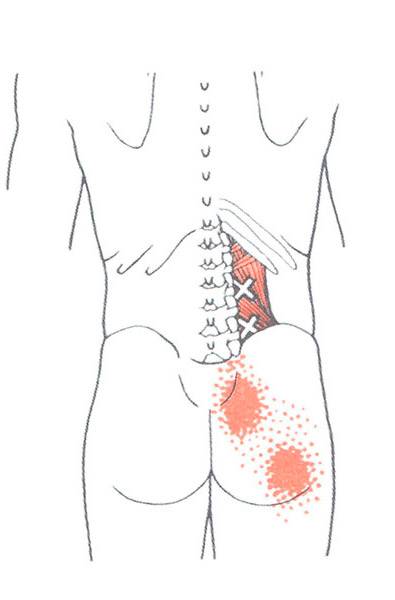Болит низ поясницы слева. Миофасциальный синдром квадратной мышцы поясницы. Болит поясница справа. Боль в спине справа. Боль в пояснице с правой стороны.