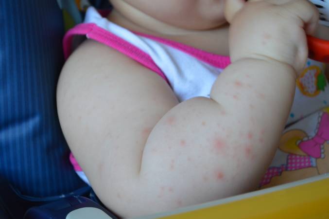 Что делать когда появилась аллергия на руках в виде красных пятен или пузырьков