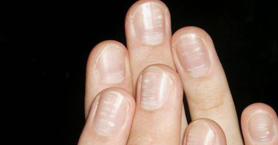 Белые точки на ногтях. причины и значения точек у детей и взрослых