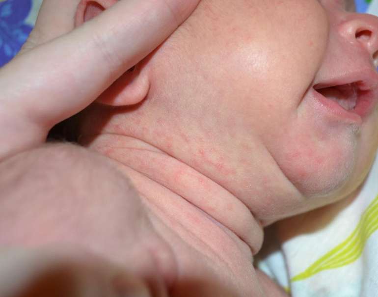 Потница у детей (28 фото): как выглядит и чем лечить потничку у новорожденных в домашних условиях, симптомы и профилактика