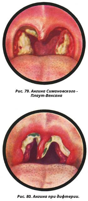 Герпетическая ангина у ребенка - лечение детей, как и чем лечить герпангину в 1 год: гексорал при герпесном тонзиллите, как вылечить спреем