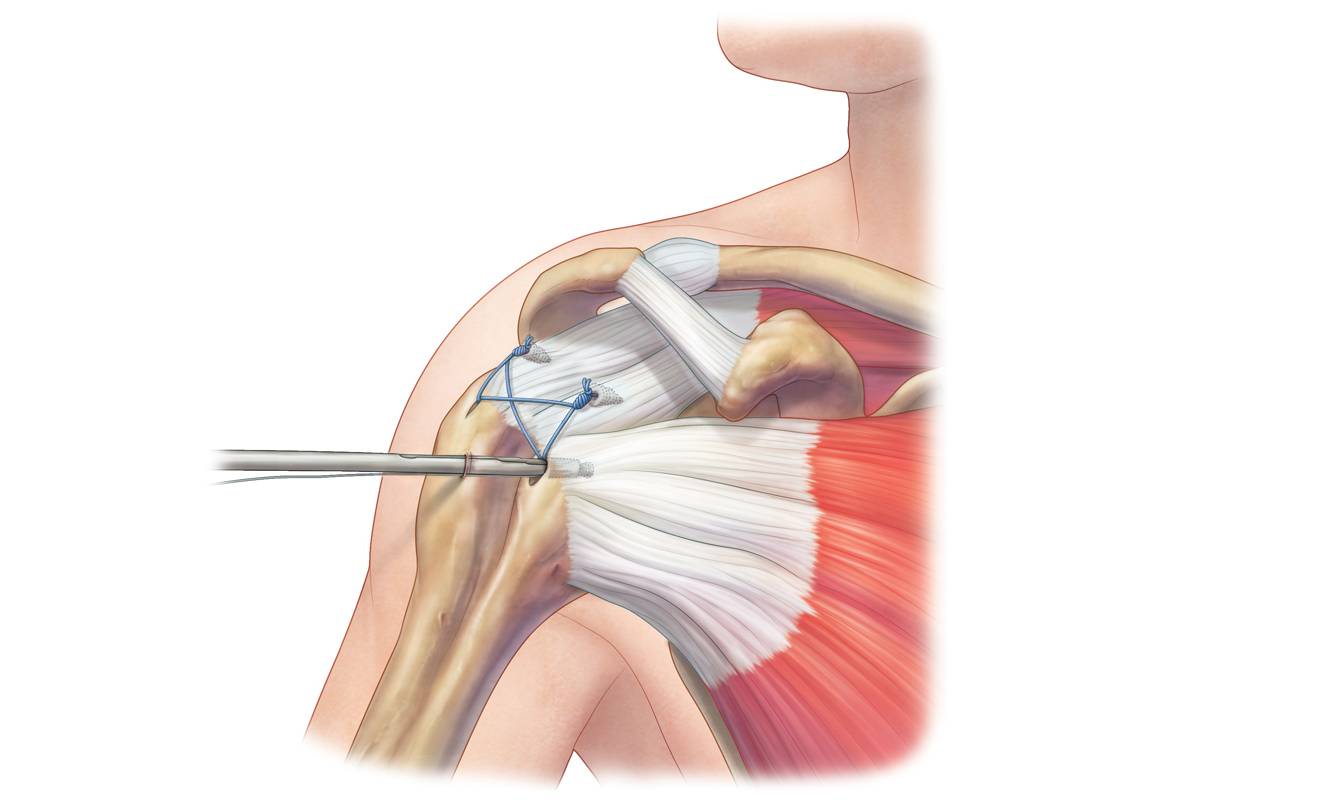 Разрыв надостного сухожилия плечевого сустава лечение. Тендинит ротаторной манжеты плечевого сустава. Кальцифицирующий тендинит плеча. Сшивание сухожилий плечевого сустава. Шов вращающей манжеты плеча плечевого сустава.
